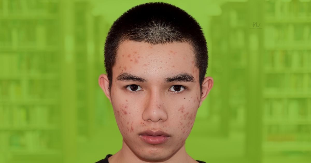 Why acne and pimples are common in adolescence?