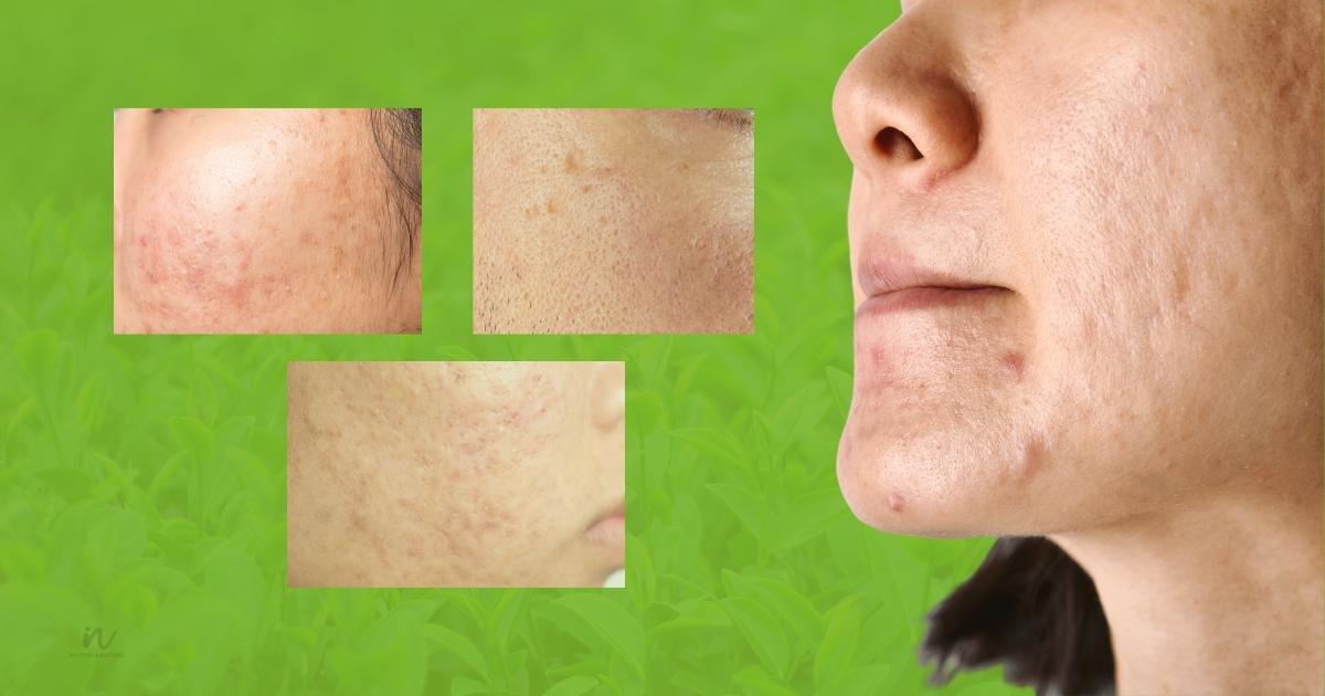 How to use tea tree oil for acne scars?