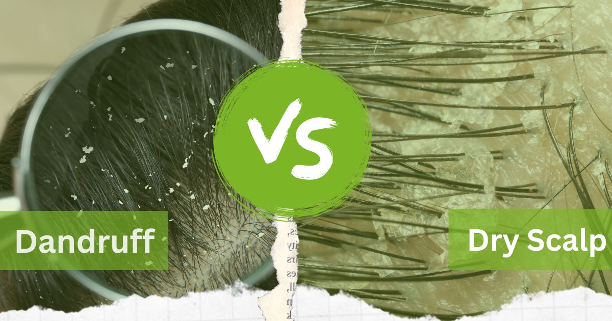 Dandruff vs Dry Scalp: How to Tell the Difference and Treat Both Naturally